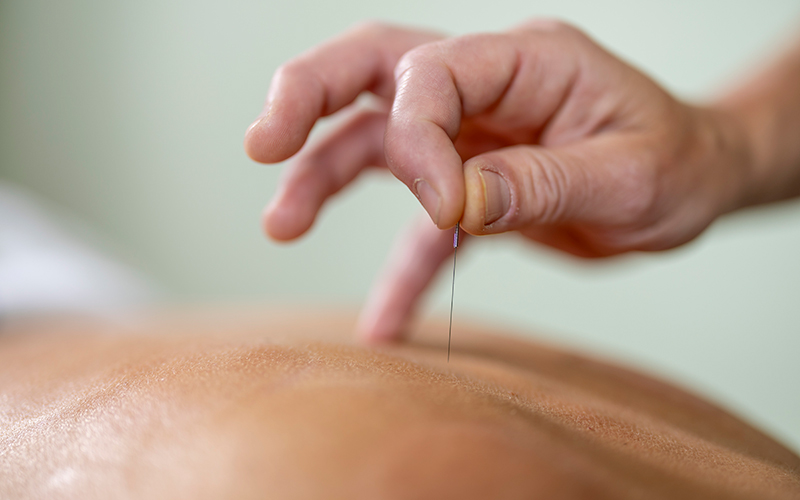 Akupunkturbehandlung am Rücken einer Person